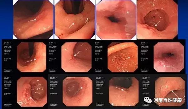 最新胃腸鏡技術(shù)，醫(yī)學(xué)領(lǐng)域的革新之星