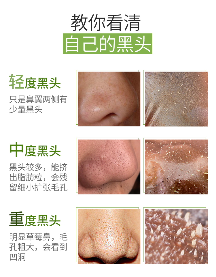 最新去黑頭教程視頻匯總，科技助力美麗重塑，黑頭無(wú)憂新篇章