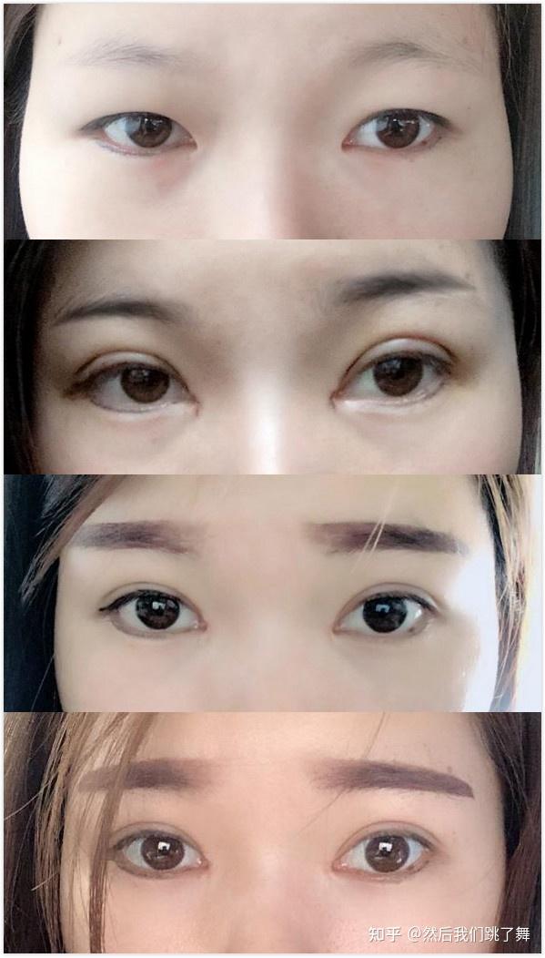 雙眼皮新技術揭秘，小明的魔法雙眼皮之旅